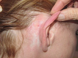 Before behind ear camouflage