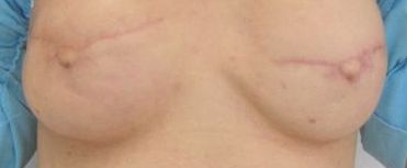 areola-before