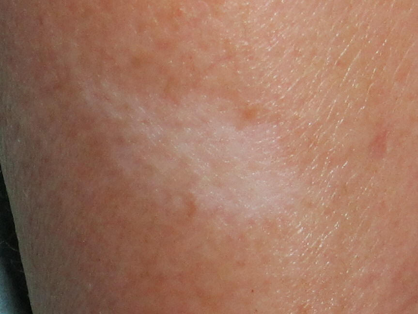arm scar before